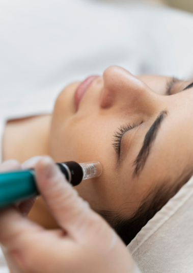 Imagem ilustrativa do tratamento Microagulhamento